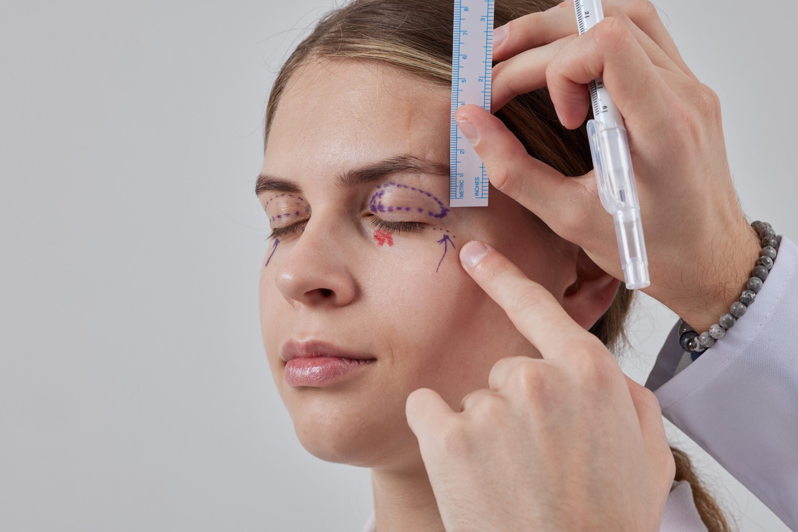 Surgeon marking a patient's eyelid before eyelid surgery